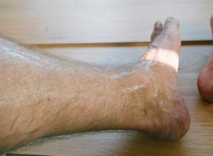 Plantar Hyperhidrosis