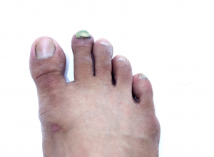Psoriasis Psoriasis of the Toenail