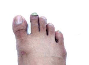 Psoriasis of the Toenail