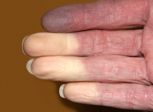 Raynaud&#039;s Phenomenon 