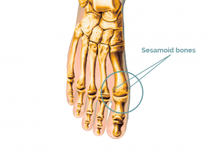 Sesamoiditis