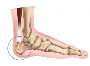 Sever&#039;s Disease