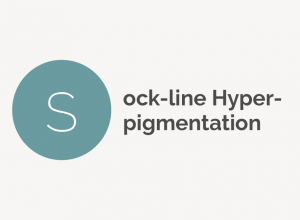 Sock-Line Hyperpigmentation Definition Sock-Line Hyperpigmentation Definition