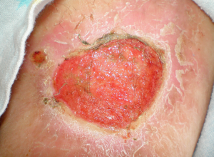 Staphylococcus Infection Staphylococcus "Staph" Infection