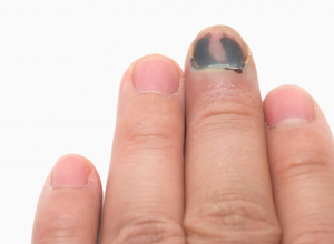 Subungual Hematoma Subungual Hematoma