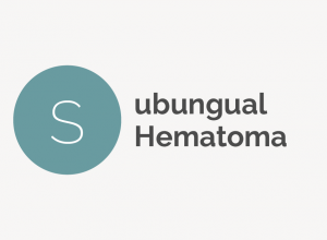 Subungual Hematoma Definition 