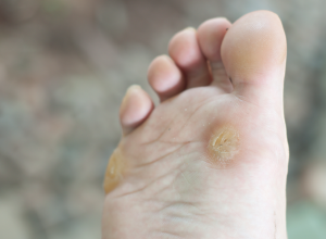 Corn Foot with corns