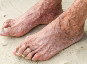 Trench Foot Trench Foot