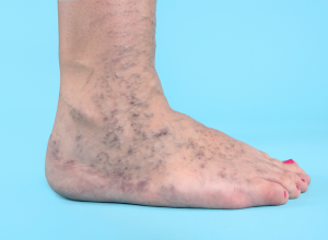 Varicose Veins