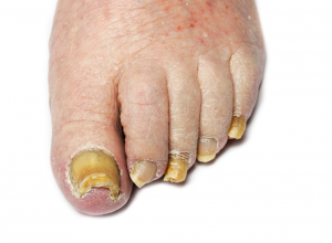 Yellow Nail Syndrome