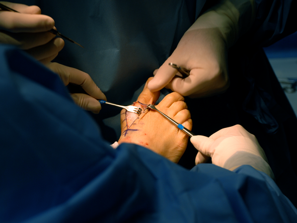 8 Mistakes Patients Make When Considering Bunion Surgery