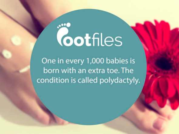 Footfiles Foot Fact Polydactyly Extra Toe