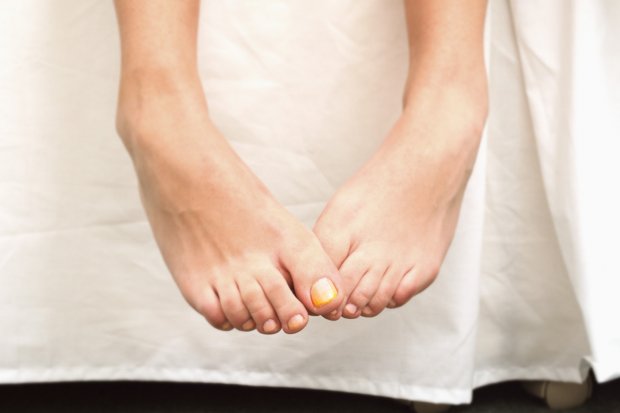 Powerful Home Remedies For Toenail Fungus Onychomycosis