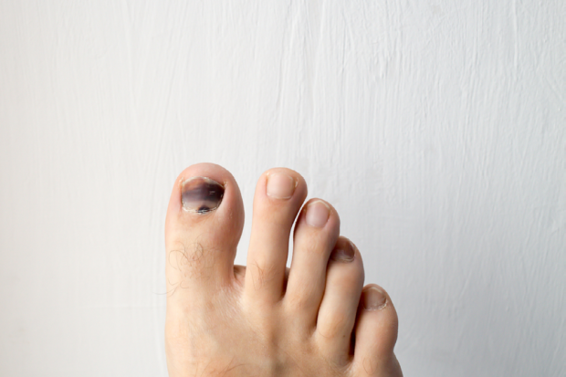 Black Toenail Causes Treatment Grow Out Facts