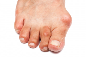 Hallux Abducto Valgus Bunion 