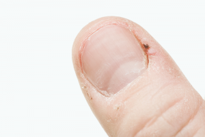 Hangnail 