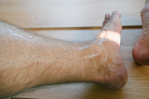 Plantar Hyperhidrosis