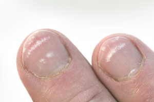 White spots on nails